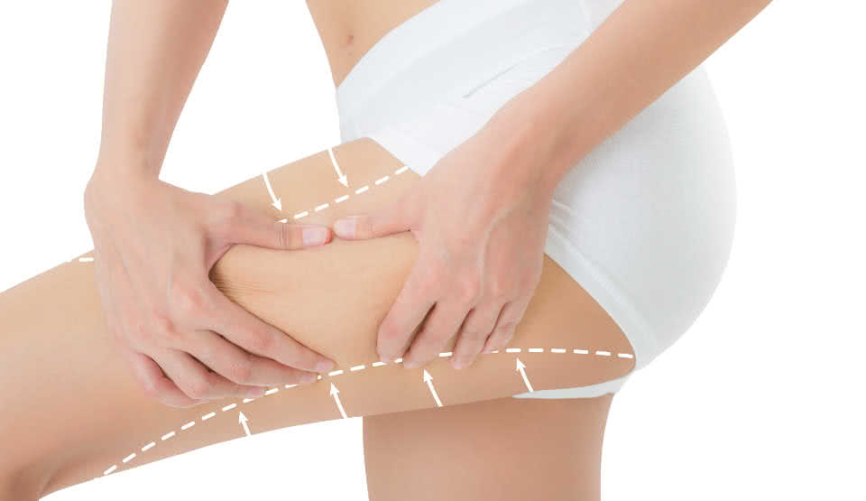 where fat can be taken from in liposuction